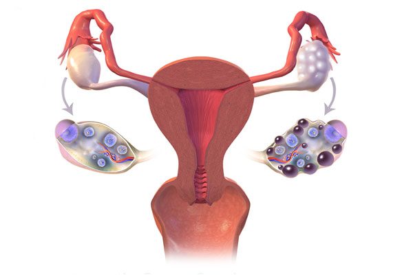 Gynecologist / obstetrician for PCOS or PCOD treatment